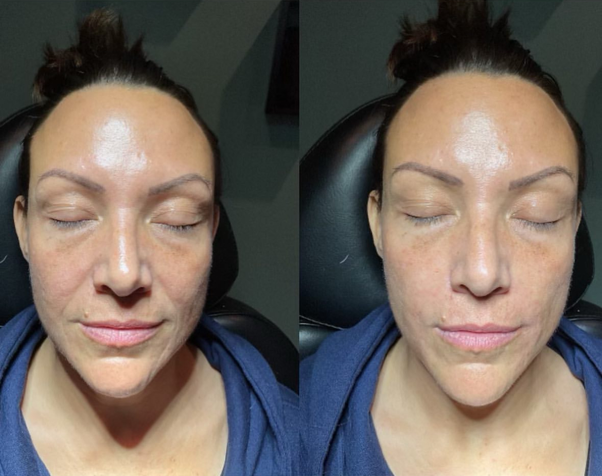 Elite Liquid Facelift - Before and After Elite Medical Spa Sarasota