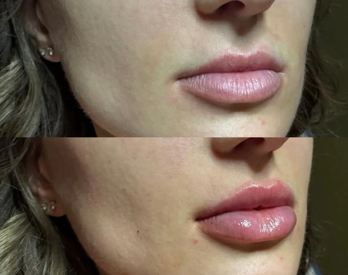 Lips Juvederm - Before and After Elite Medical Spa Sarasota