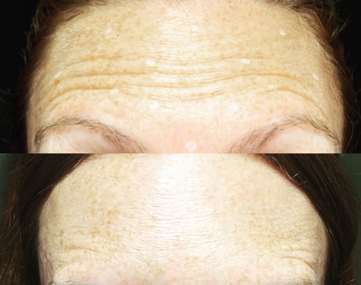 BoTox - Before and After Elite Medical Spa Sarasota
