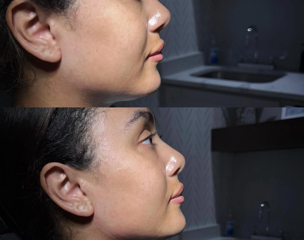 Jawline Skinvive - Before and After Elite Medical Spa Sarasota