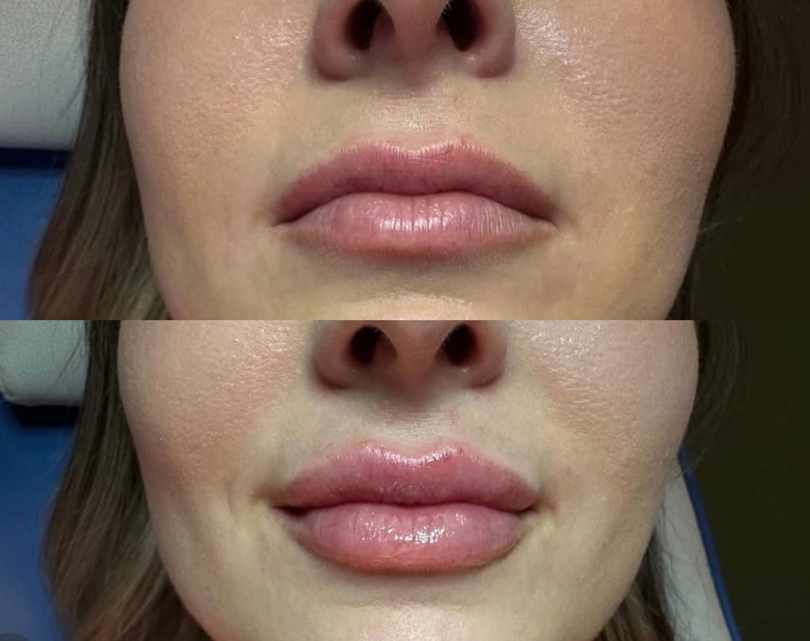 Lips Juvederm Treatment Before and After - Elite Medical Spa