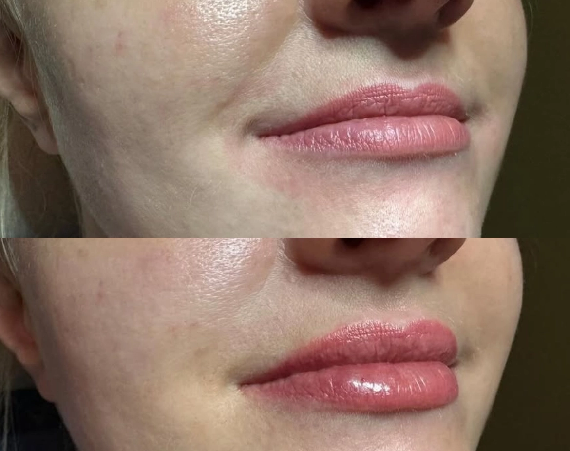 Lips Juvederm - Before and After Elite Medical Spa Sarasota