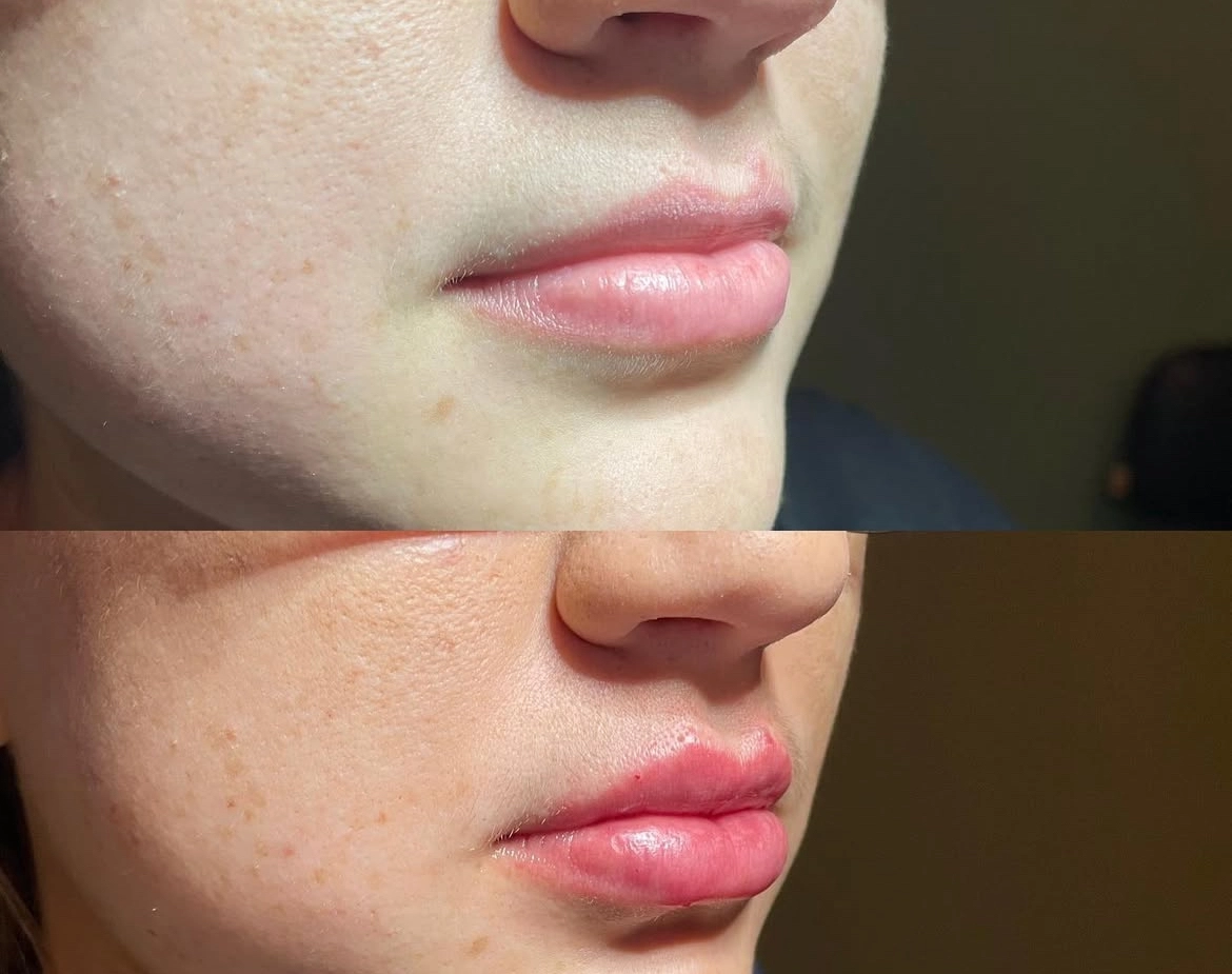 Lips Juvederm Before and After - Elite Medical Spa