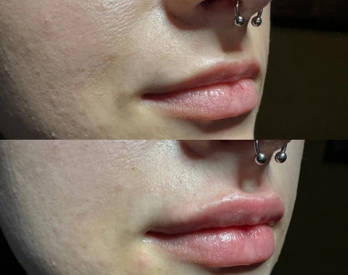 Lips Juvederm - Before and After Elite Medical Spa