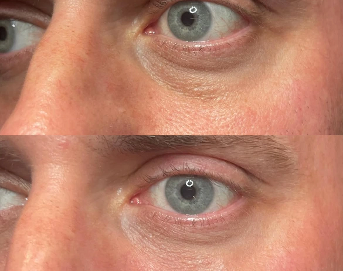 Elite Under Eyes - Before and After Elite Medical Spa Sarasota