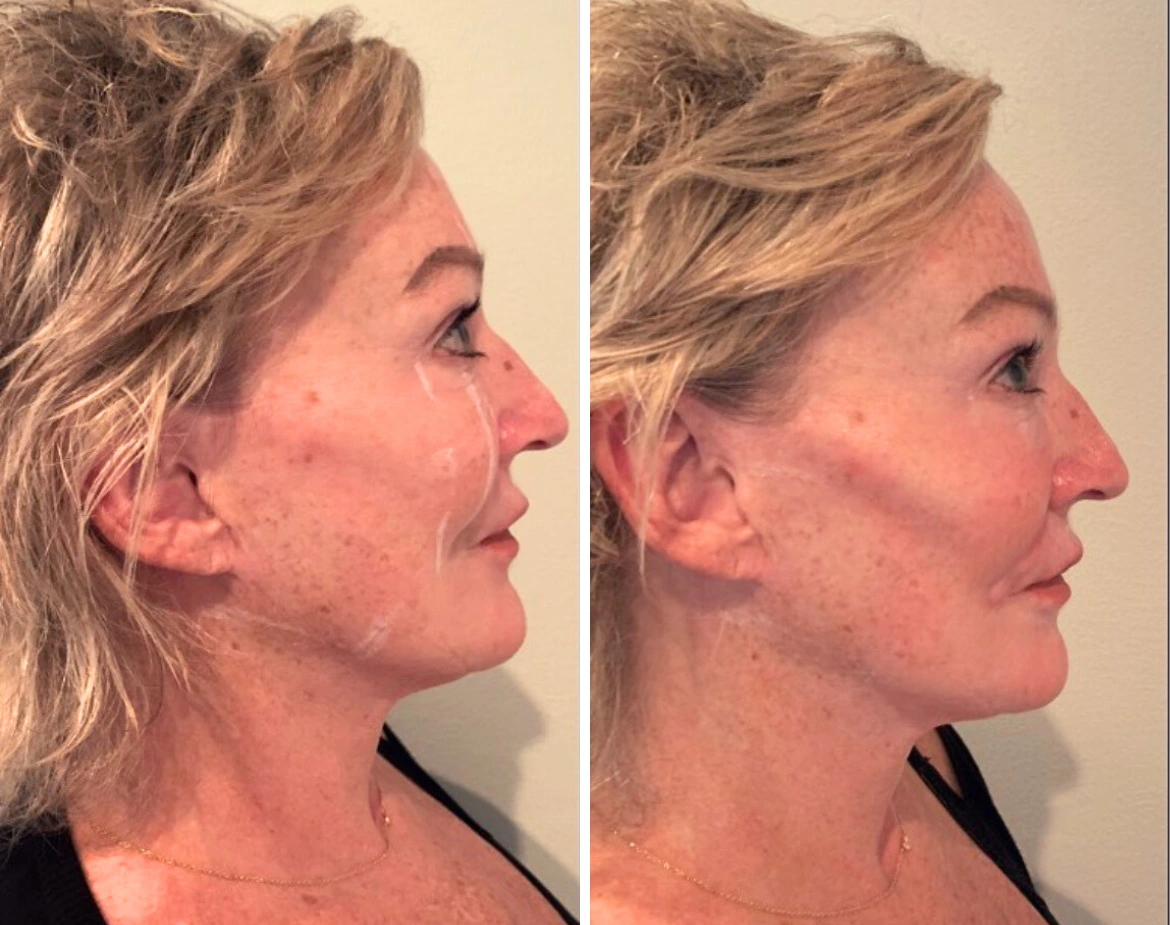 Cheeks Radiesse - Before and After Elite Medical Spa Sarasota