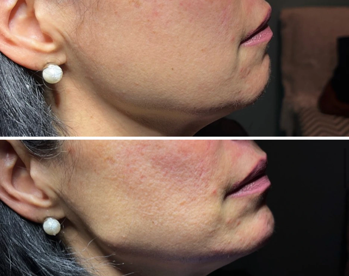Jawline Skinvive - Before and After Elite Medical Spa Sarasota