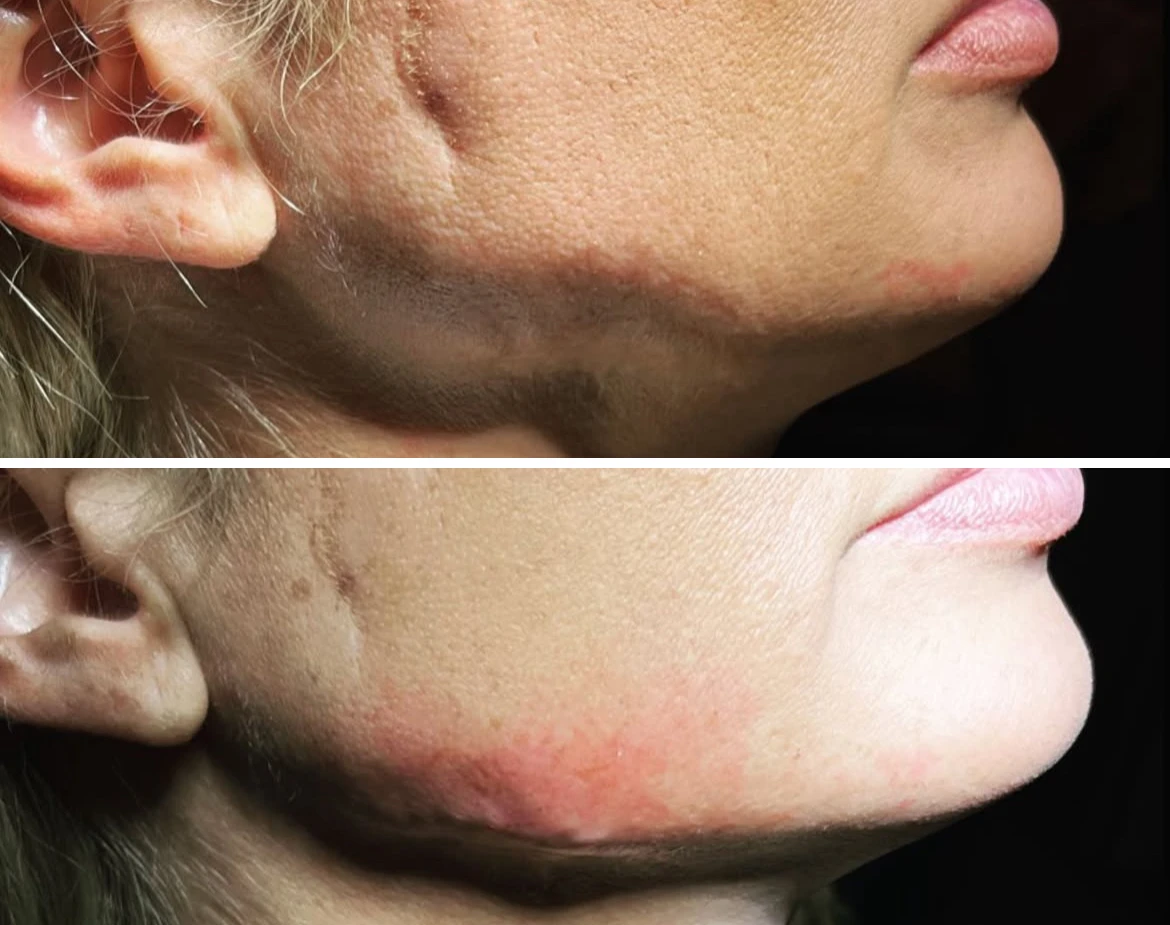 Jawline Skinvive - Before and After Elite Medical Spa Sarasota