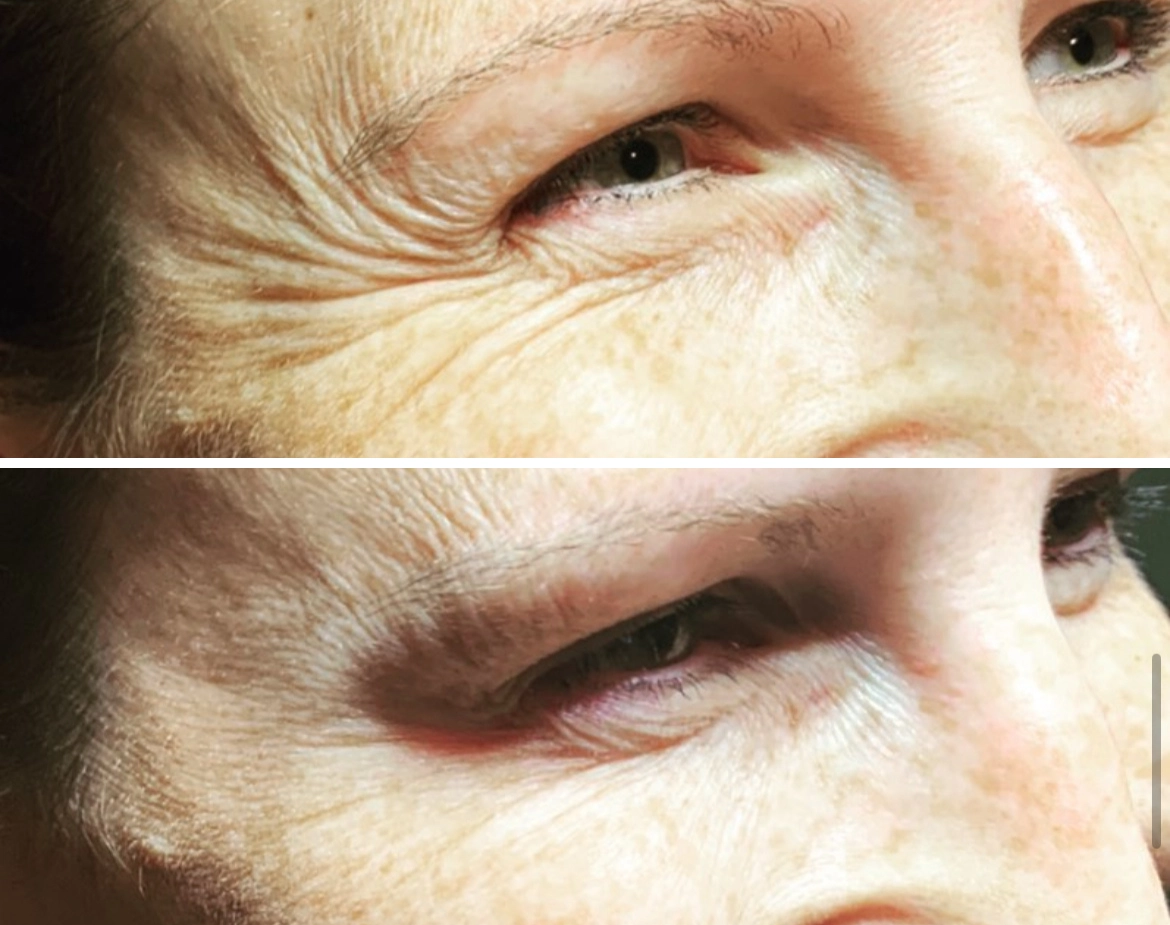 Elite BoTox - Before and After Elite Medical Spa Sarasota