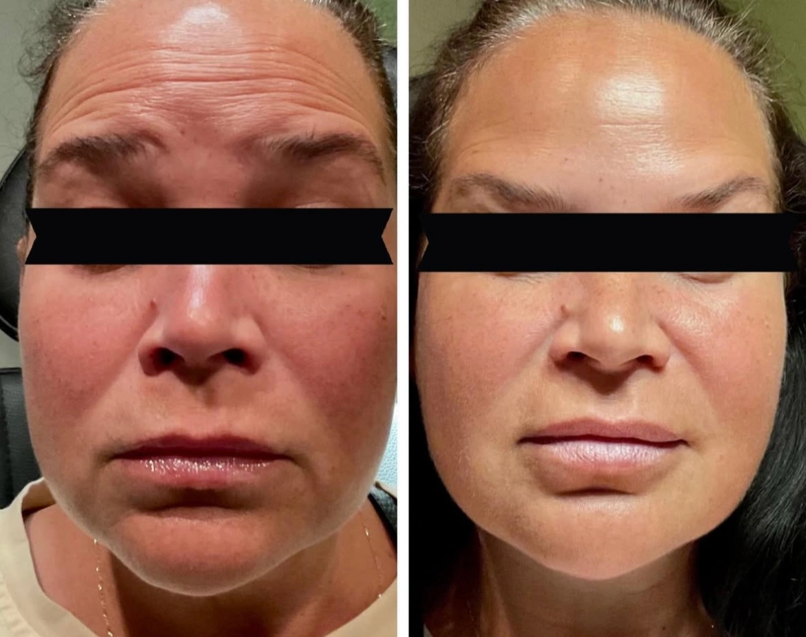 BoTox Treatment - Before and After Elite Medical Spa Sarasota