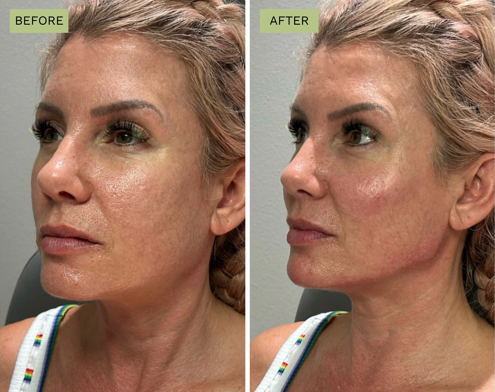 Elite Cheek and Elite Jawline Filler - Jeff Goldstein, PA-C