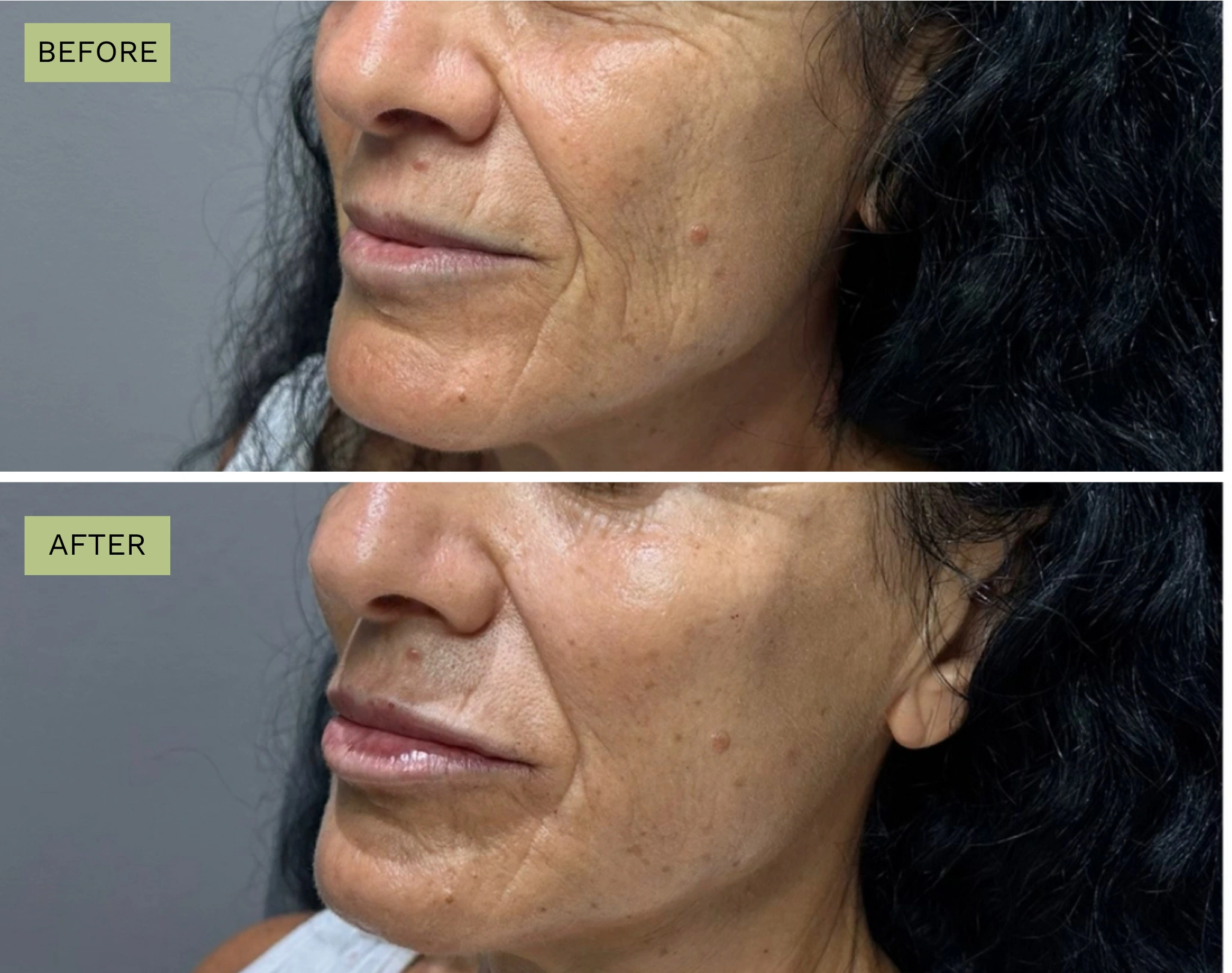 Elite Liquid Facelift - Jeff Goldstein, PA-C
