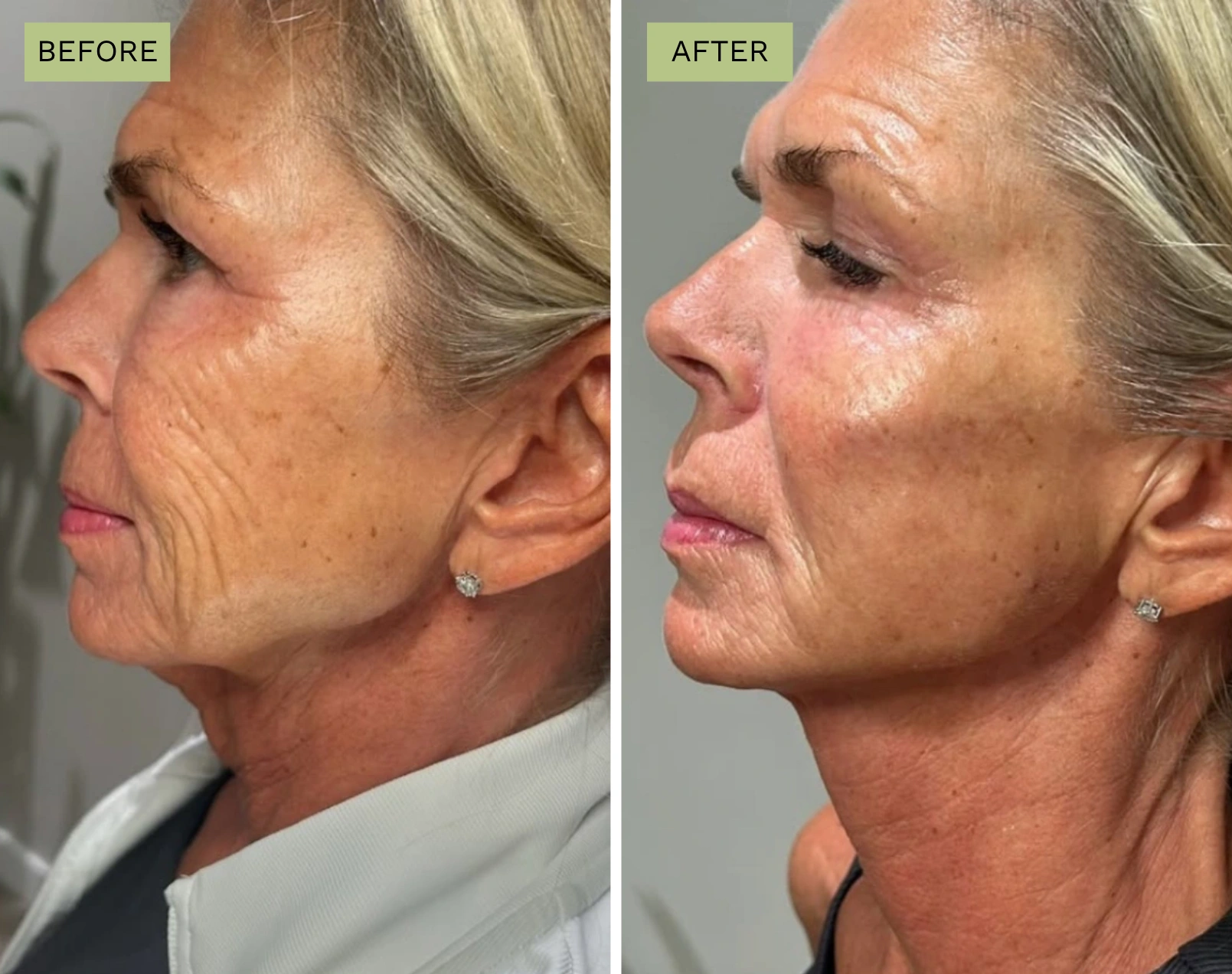 Elite Liquid Facelift  - Jeff Goldstein, PA-C