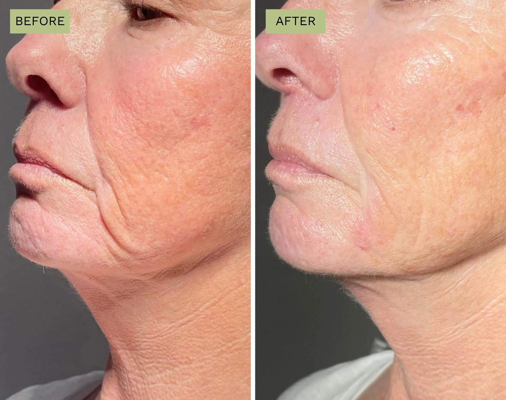 Elite Liquid Facelift  - Melanie Hartsell, APRN-C