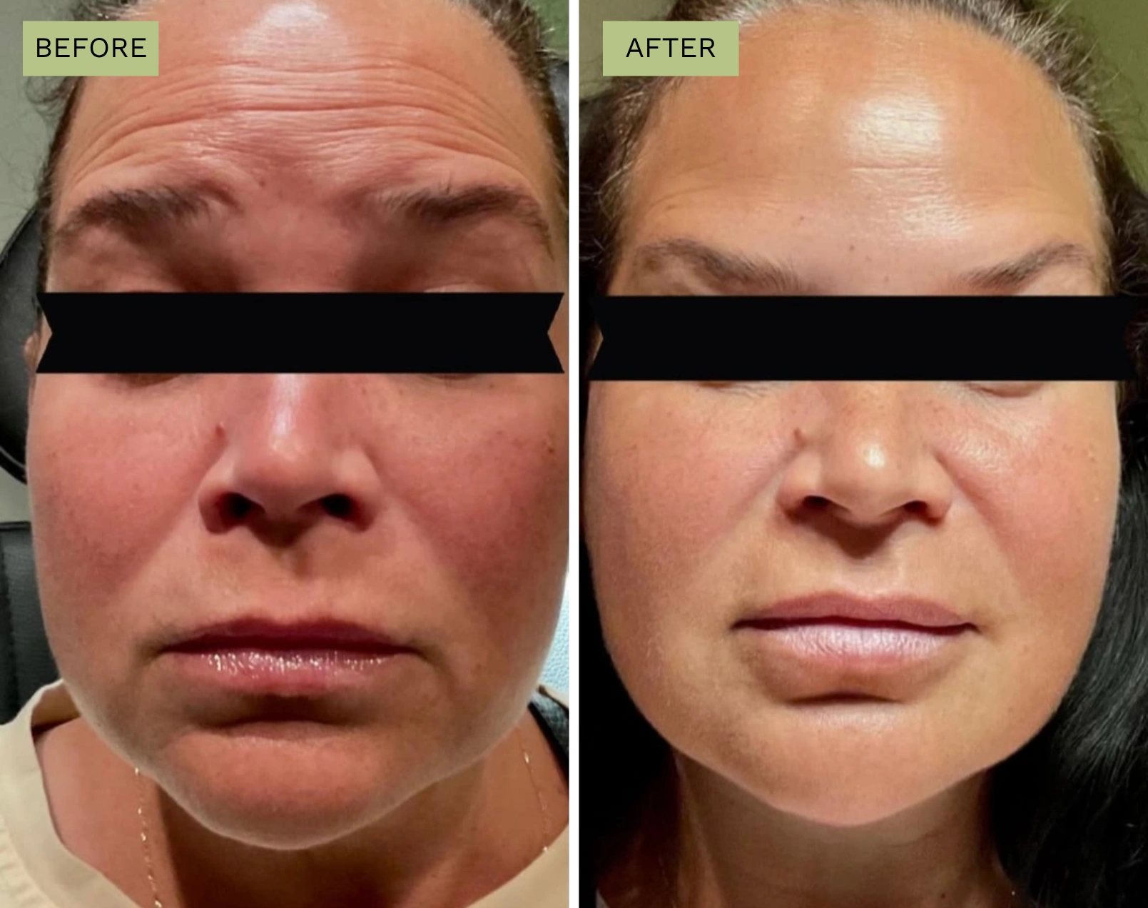 BoTox Treatment in Parrish | Elite Medical Spa