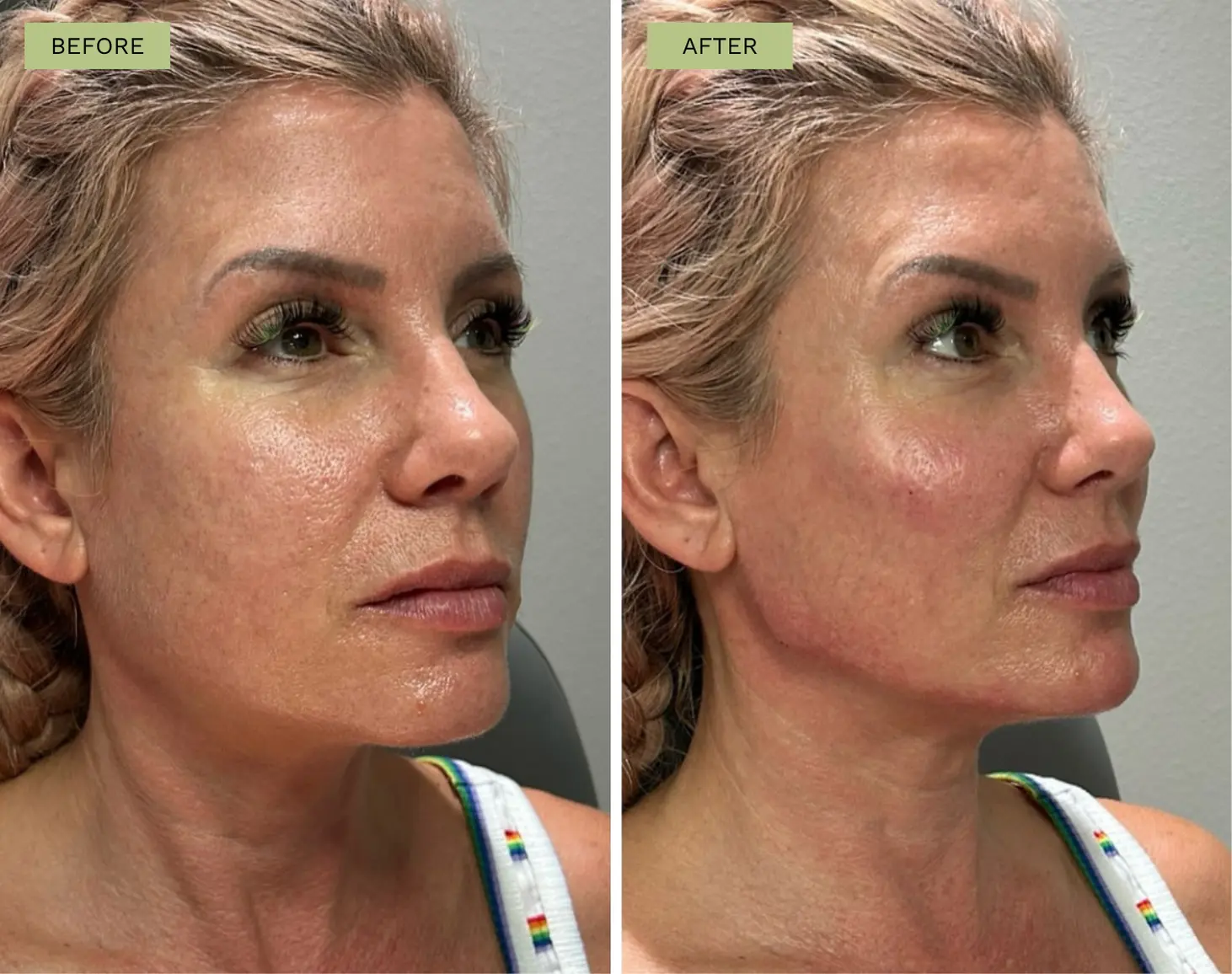Elite Cheek and Elite Jawline Filler with Radiesse - Jeff Goldstein