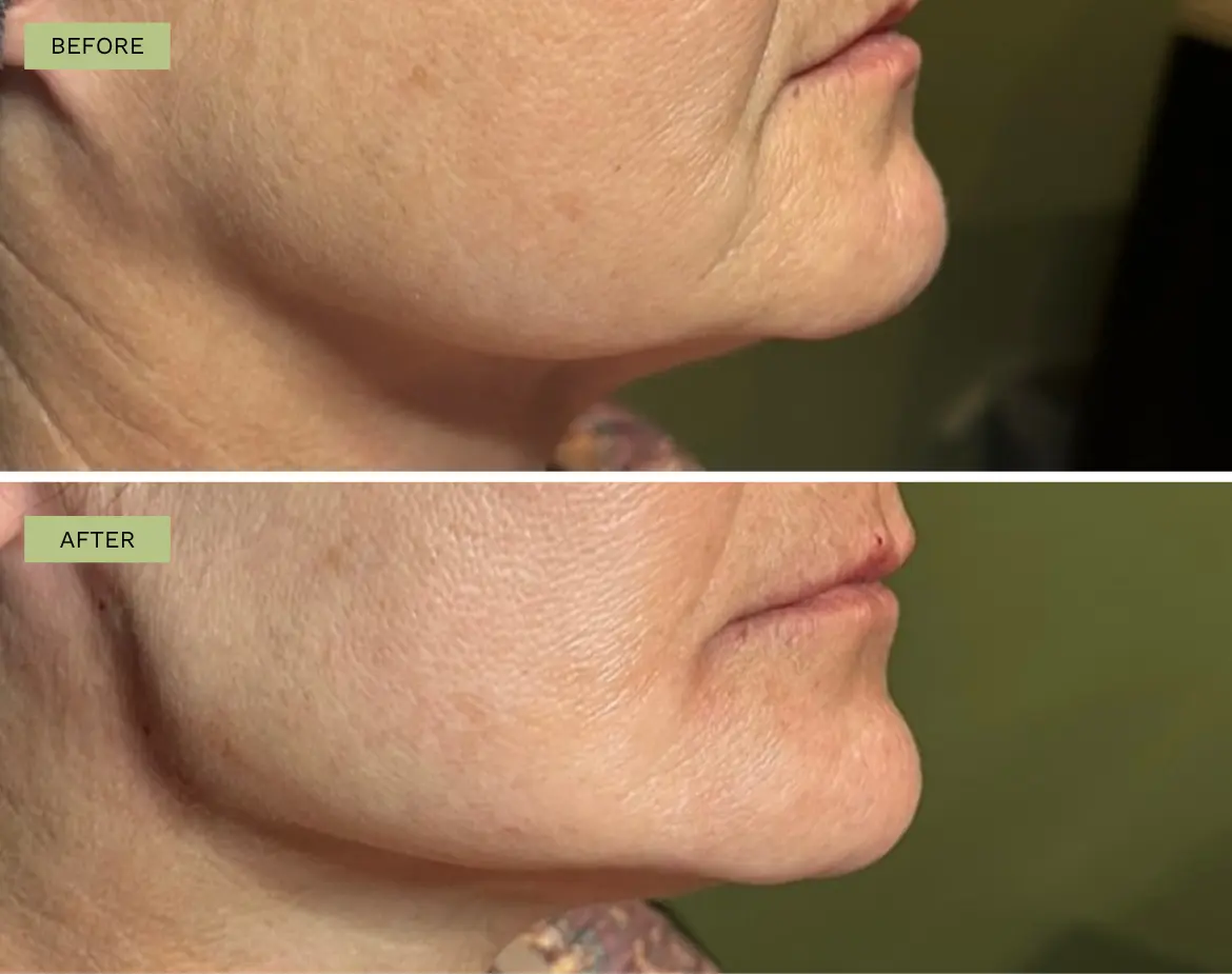 Elite Jawline Filler with Radiesse - Jeff Goldstein