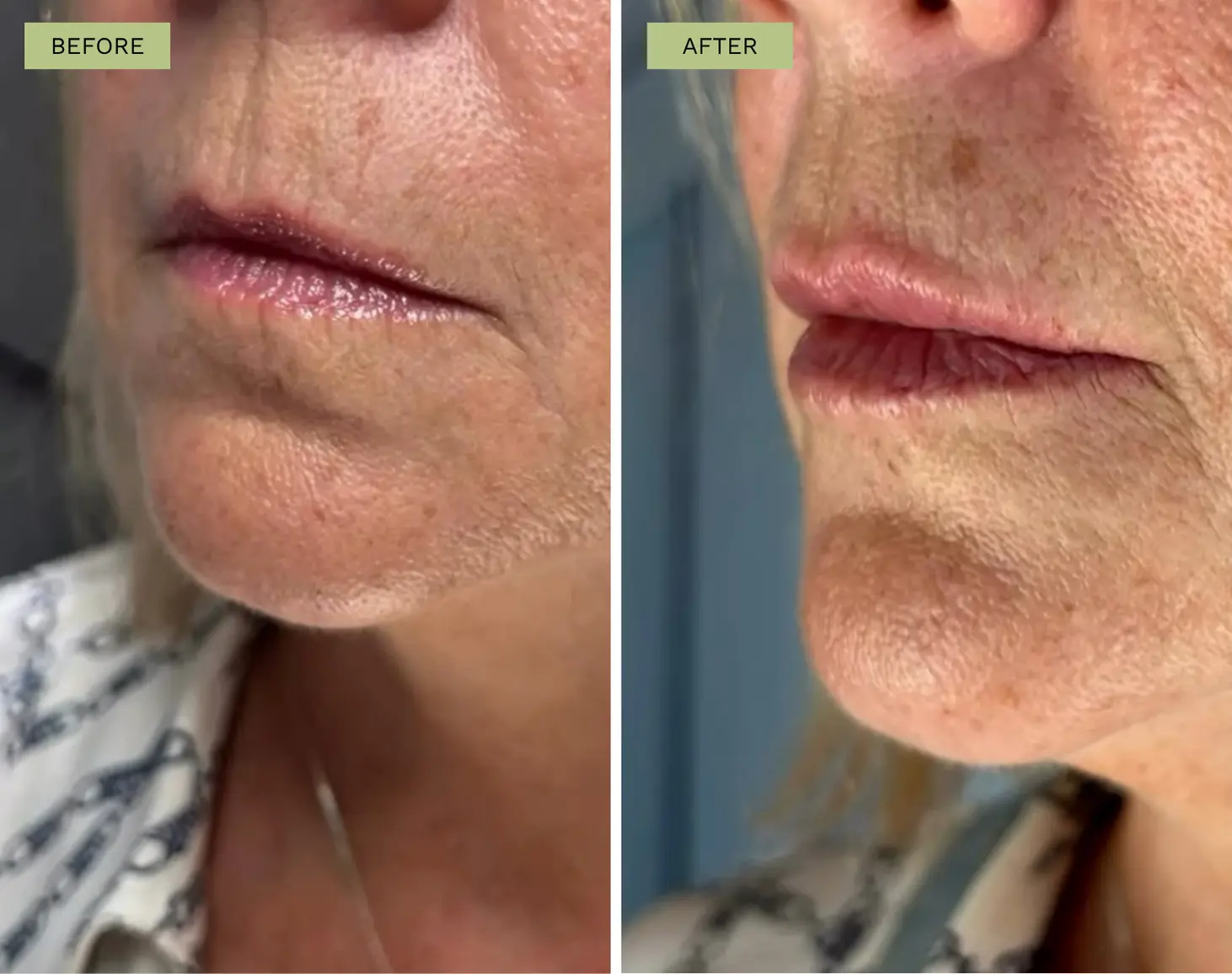 Elite Lip Filler with Juvederm - Jeff Goldstein