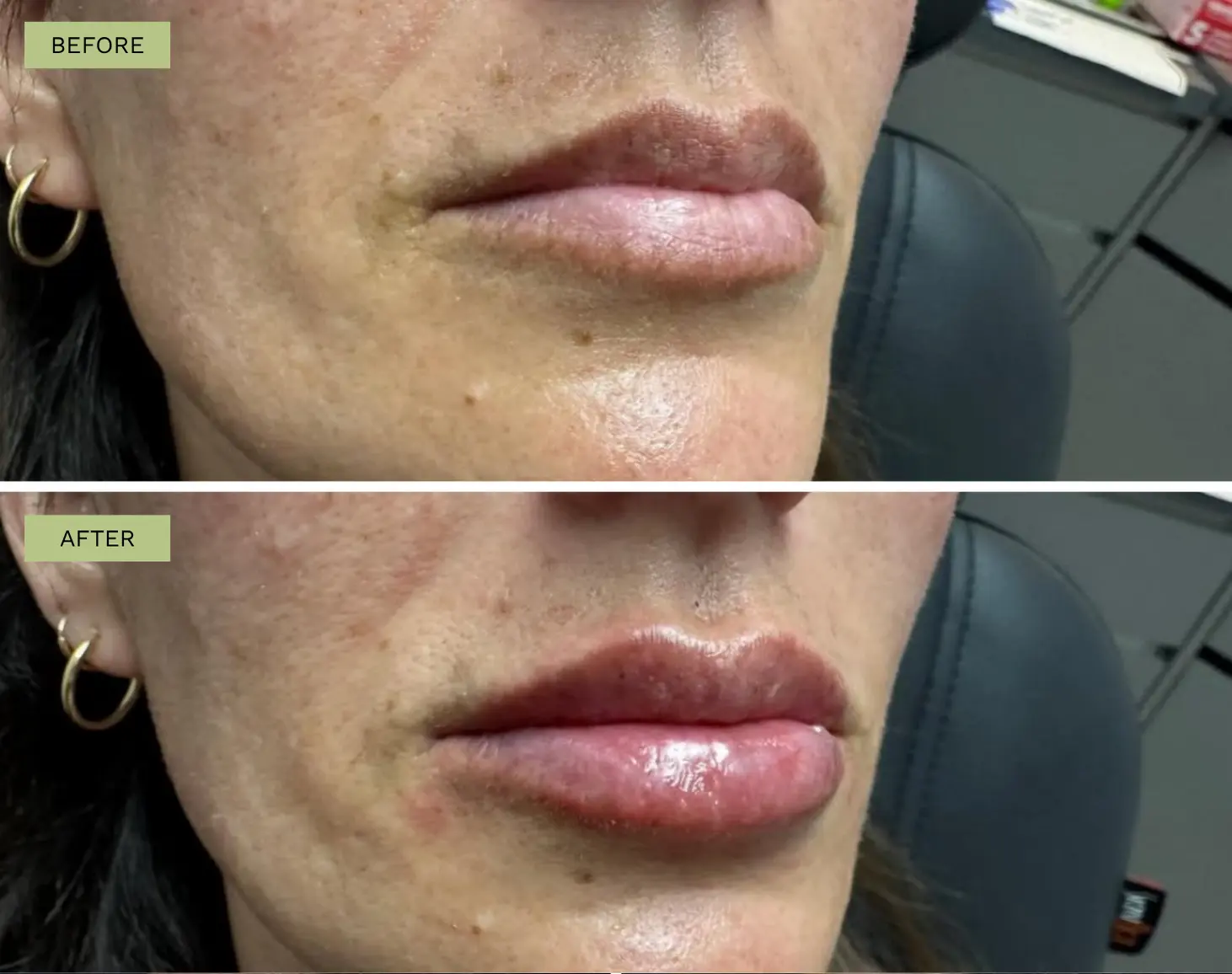 Elite Lips Filler with Juvederm