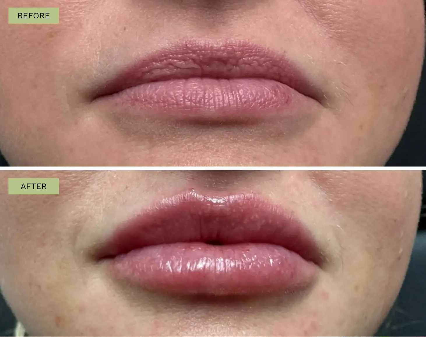 Elite Lips Filler with Juvederm