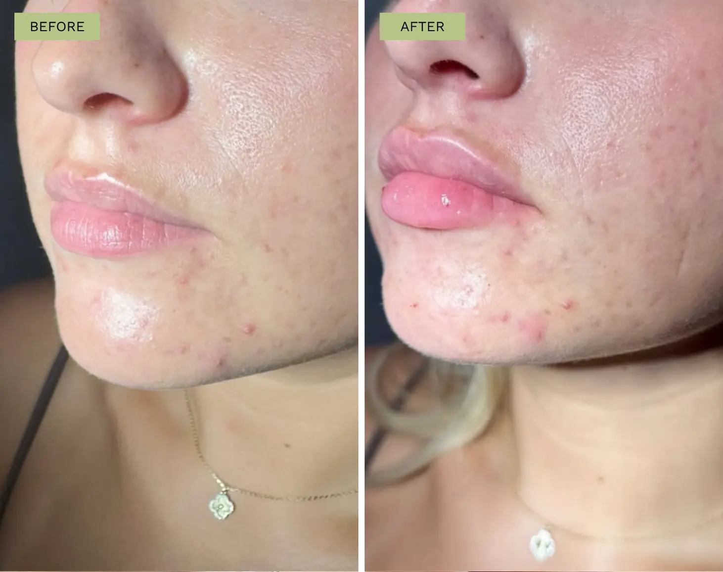 Elite Lips Filler - Melanie Hartsell