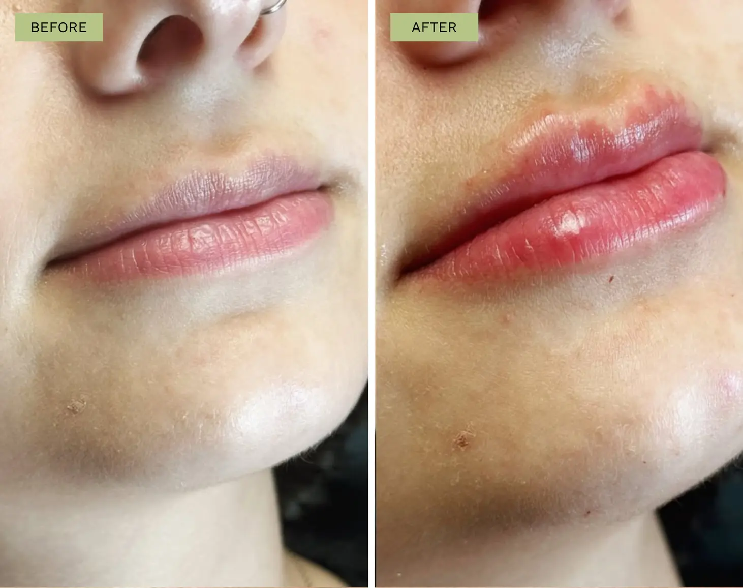Elite Lips Filler - Melanie Hartsell