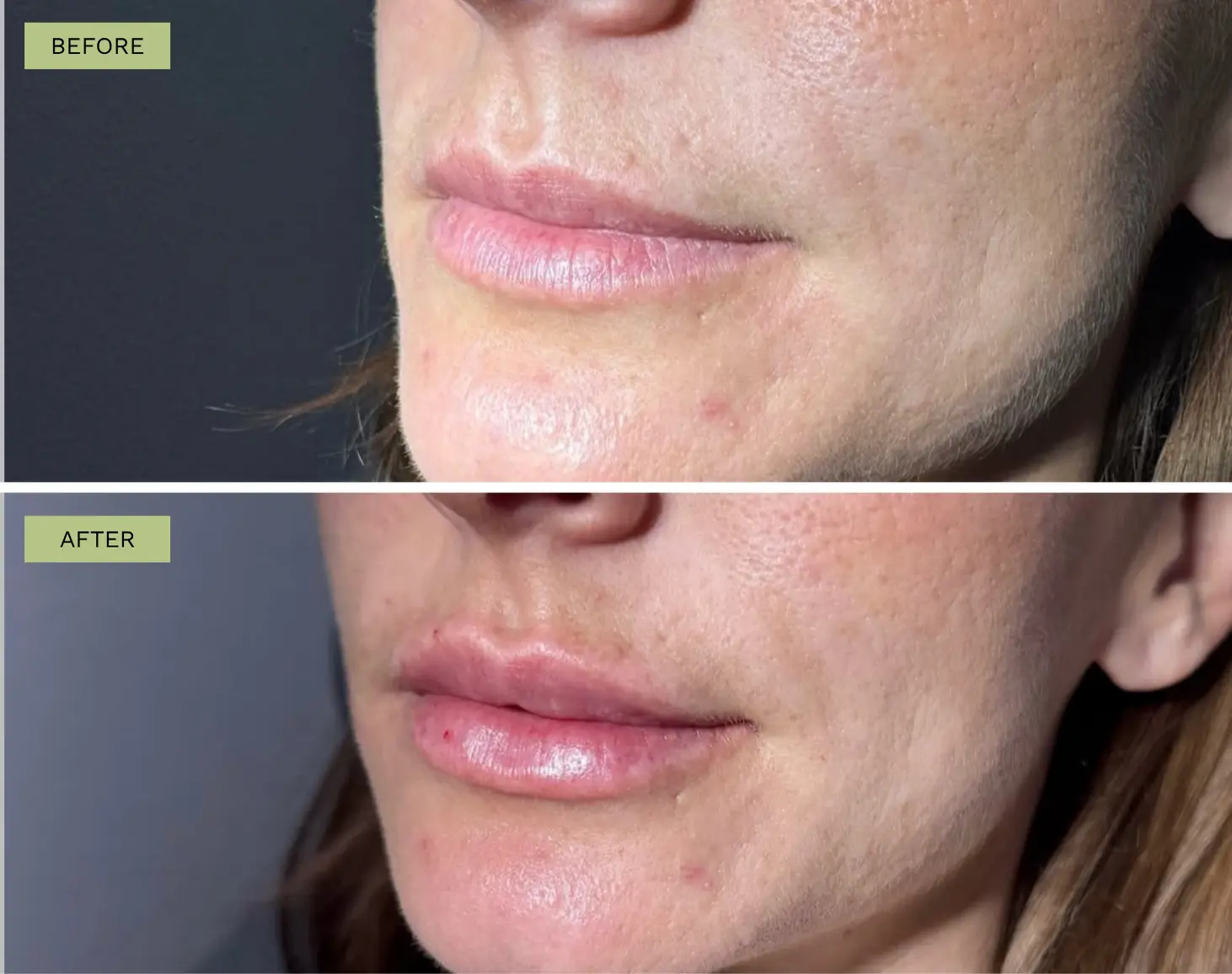 Elite Lips Filler - Melanie Hartsell
