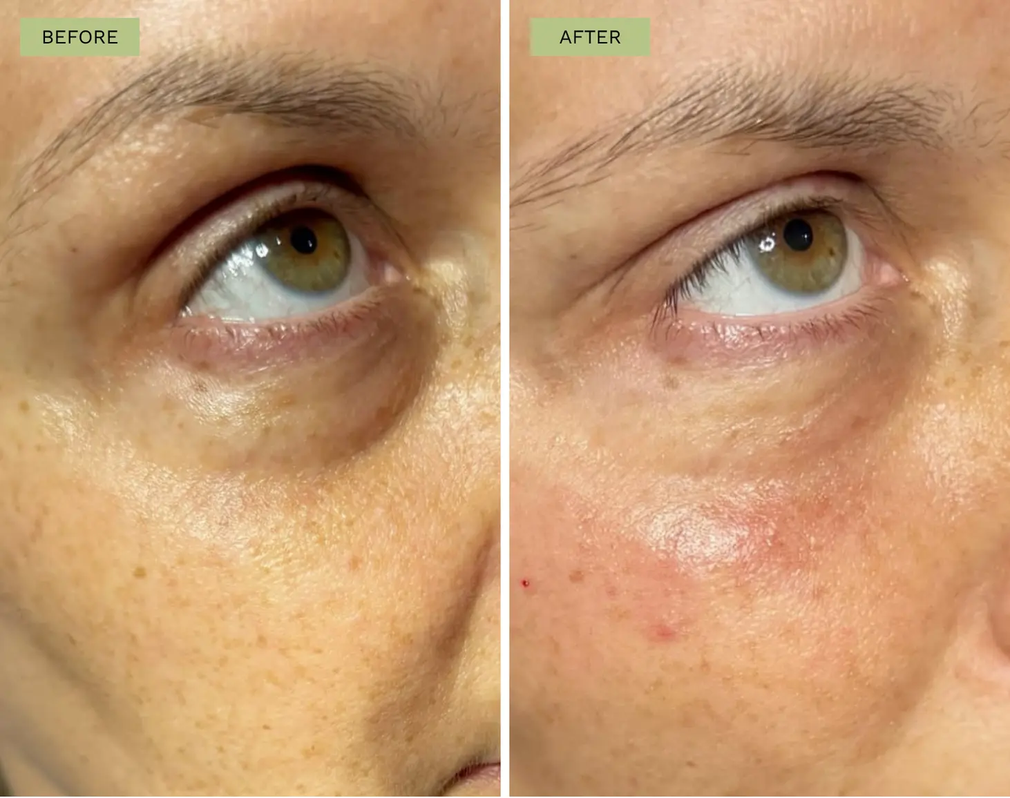 Elite Under Eye Filler with Belotero - Melanie Hartsell