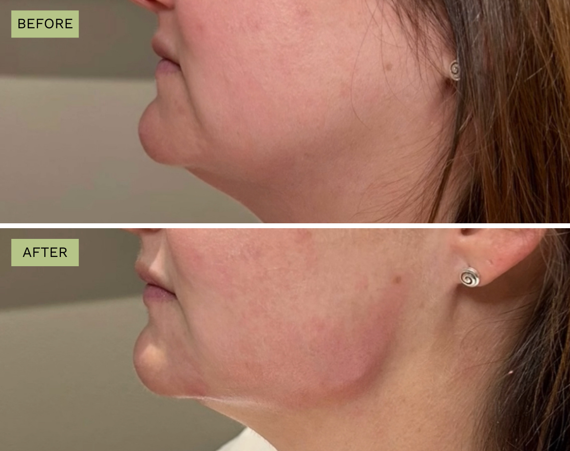 Elite Jawline - Jeff Goldstein, PA-C