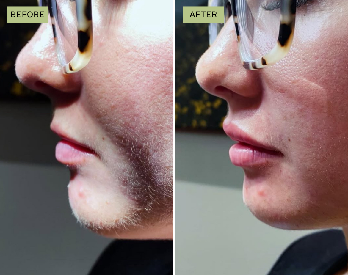 Elite Lips - Juvederm