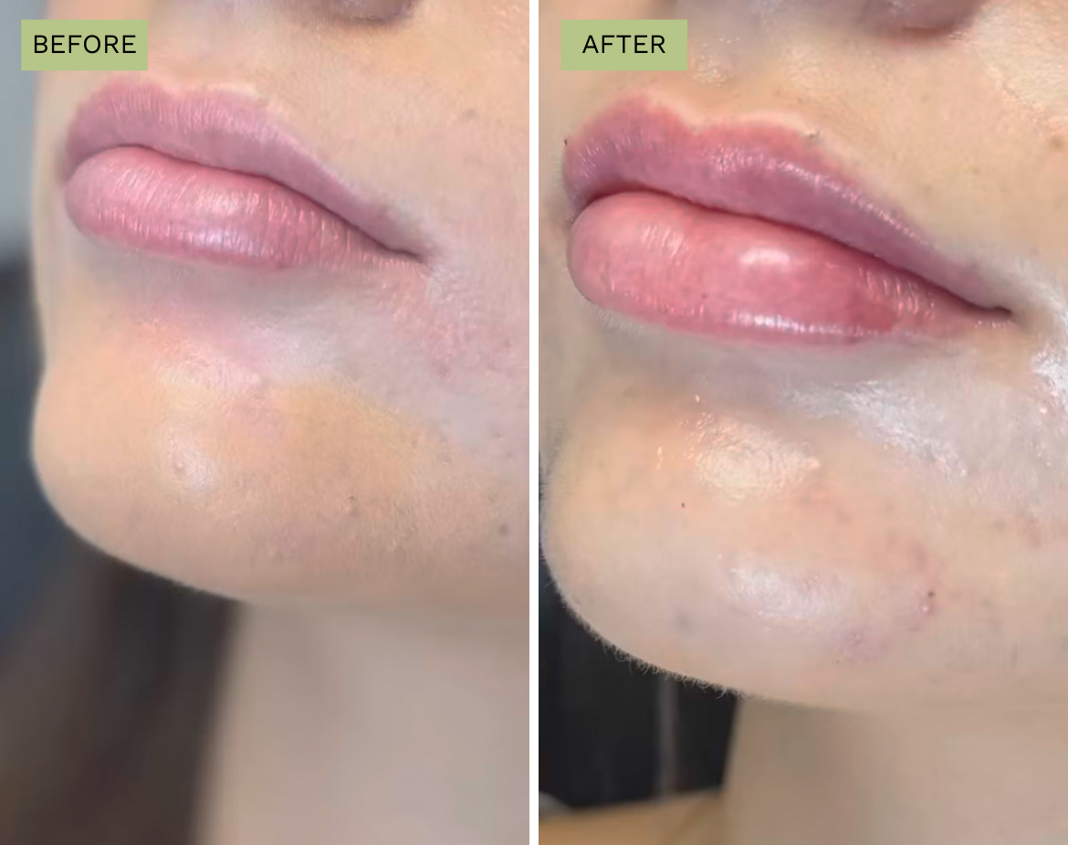 Elite Lips - Juvederm