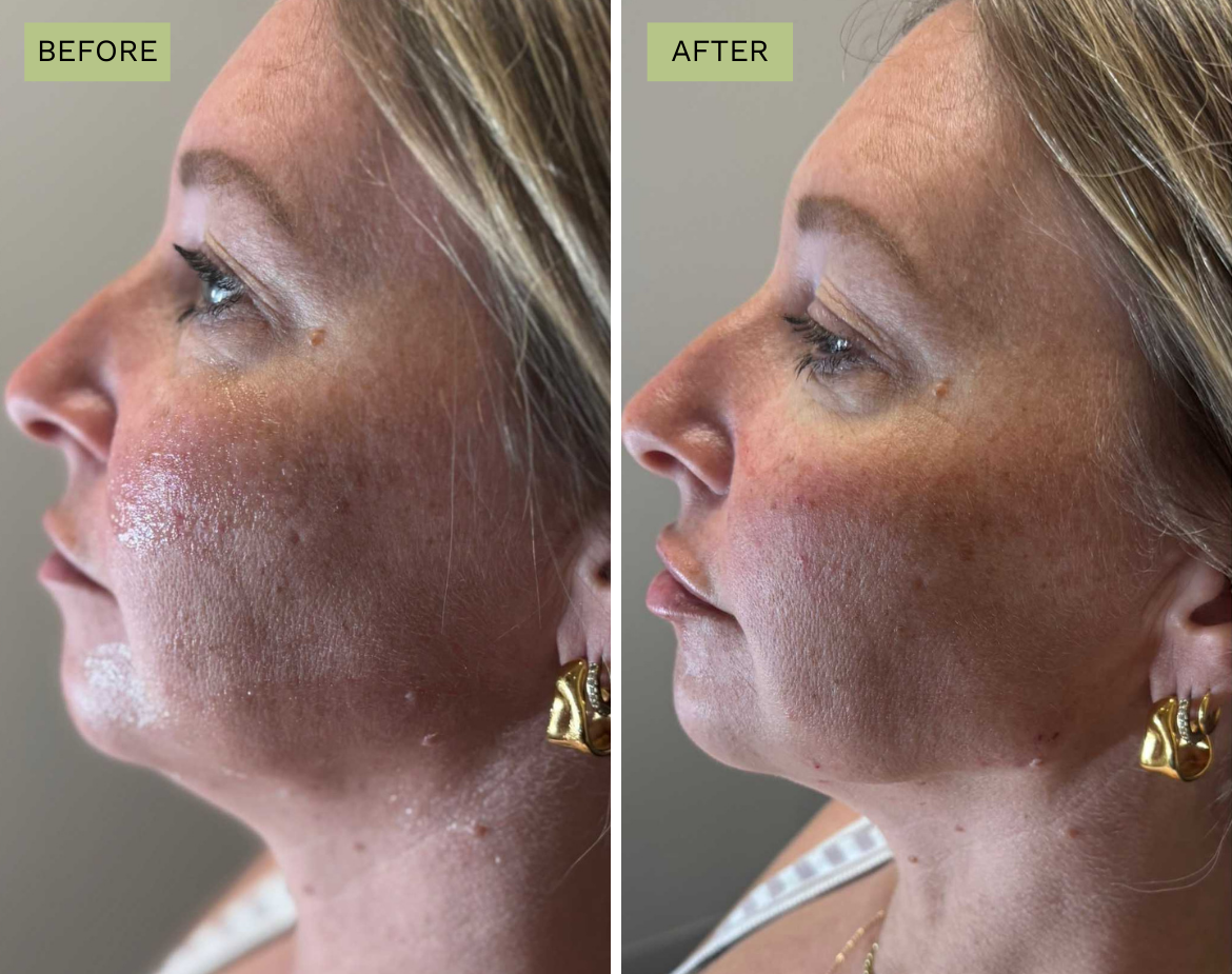 Elite Lips - Juvederm