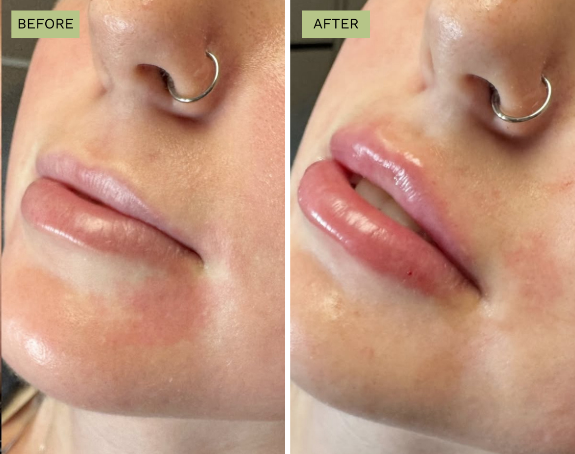 Elite Lips - Juvederm
