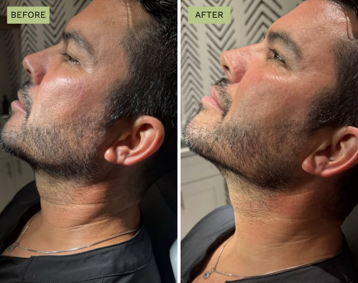 Elite Jaw Line - Radiesse
