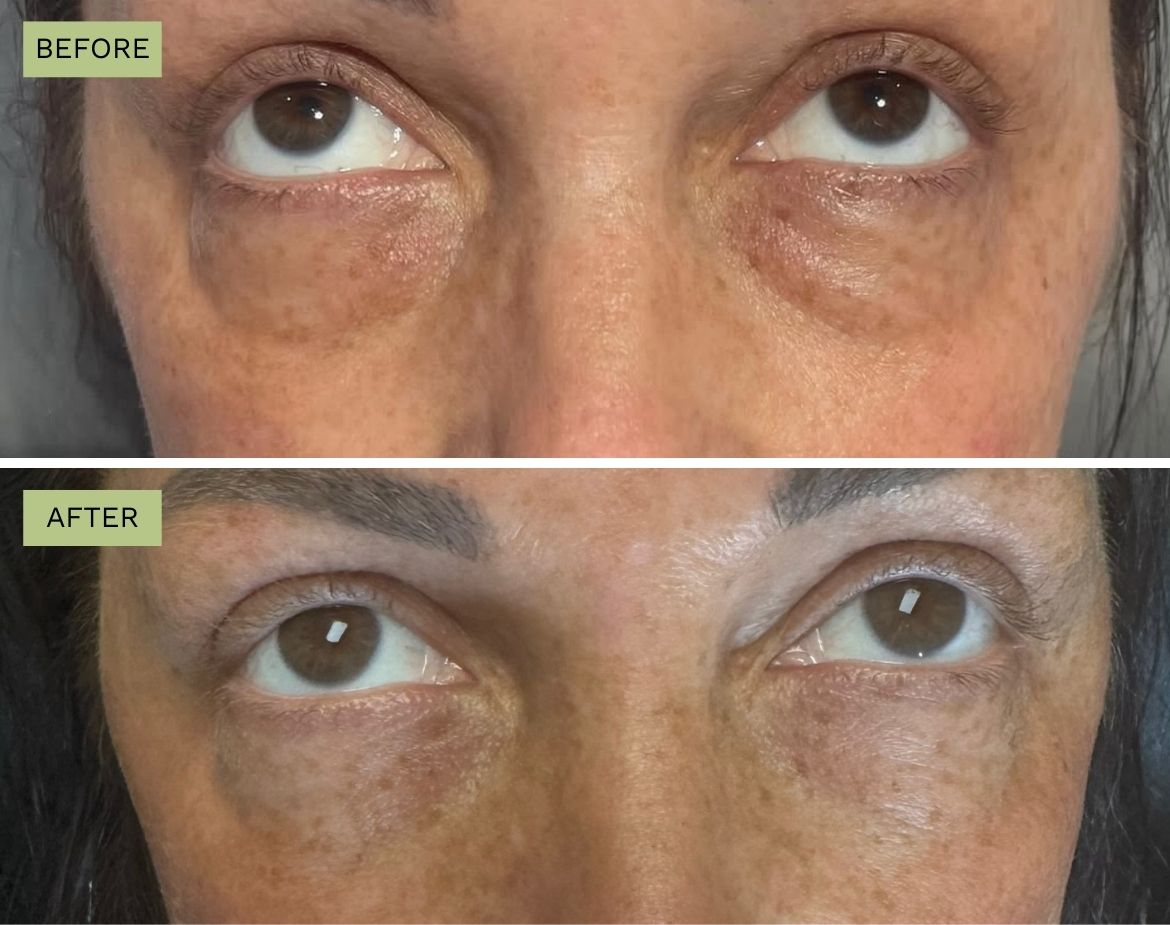 Belotero Under Eyes