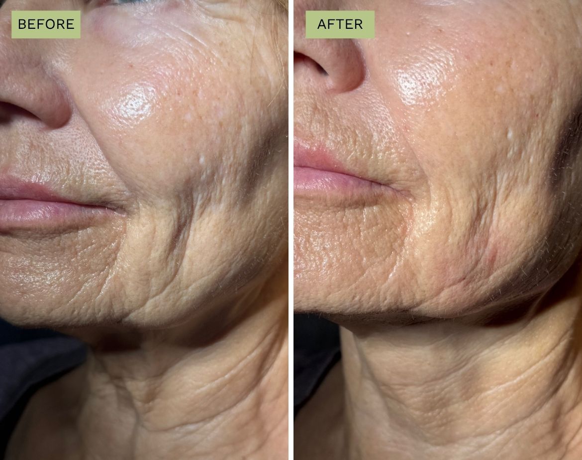 Belotero to Radial Cheek Lines