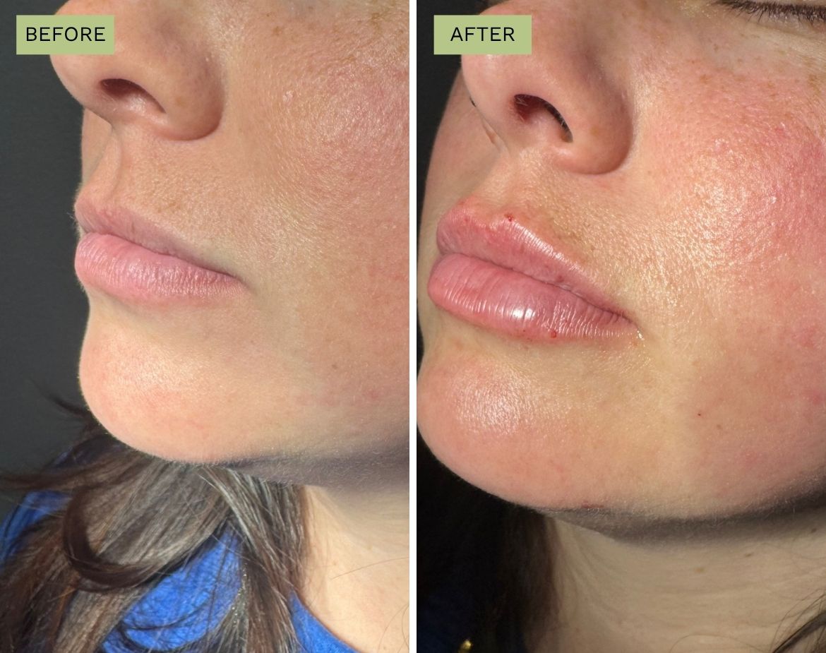 Lips with Juvederm Plus