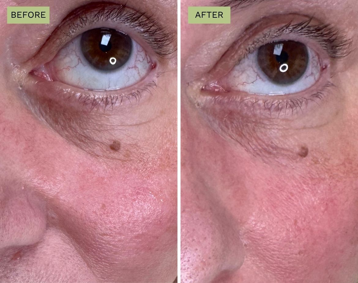 Elite Under Eyes with Belotero